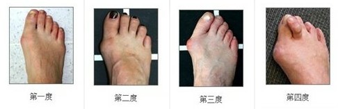 拇外翻的四大发展阶段