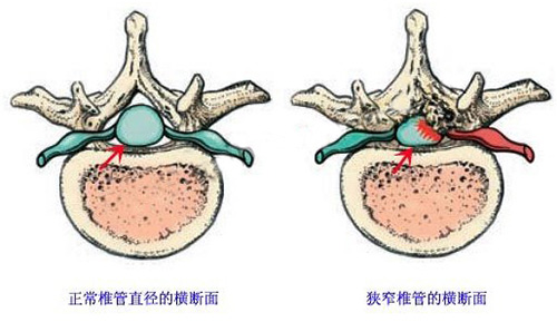 椎管狭窄示意图