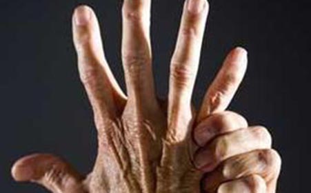 类风湿关节炎的病因与发病机制
