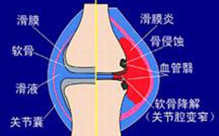 膝盖为什么会疼痛 是关节炎吗?