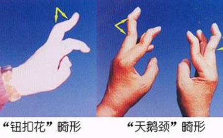 关节炎是如何产生的
