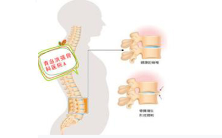 颈腰椎病的治疗
