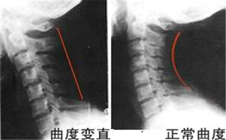 走出颈椎病诊治误区