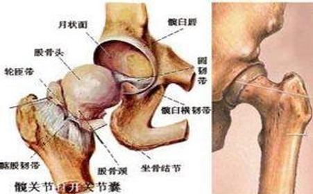 股骨头坏死症状都有哪些