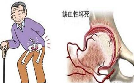 股骨头坏死的分类有哪些?