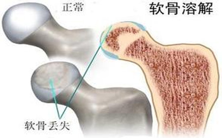 股骨头坏死的症状是哪些呢