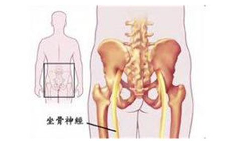 坐骨神经痛容易和哪些疾病混淆