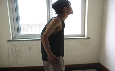 强直性脊柱炎患者应该注意什么