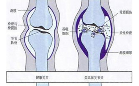 类风湿关节炎的预后怎样