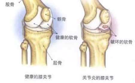 预防风湿性关节炎有效手段是什么