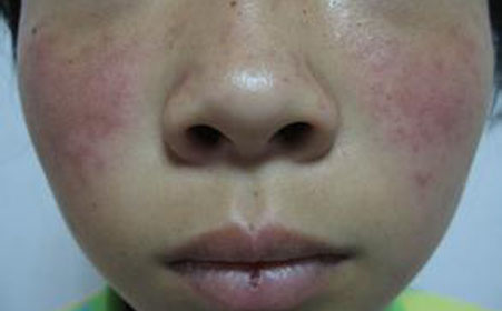 类风湿关节炎和哪些疾病相似?