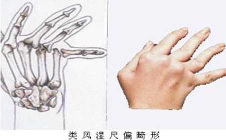 类风湿性关节炎易误诊