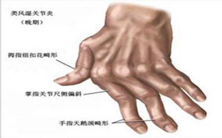 风湿性关节炎的常见表现都有什么呢